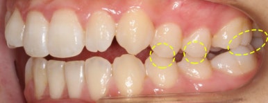 조기접촉 교정 전 관련 이미지 3