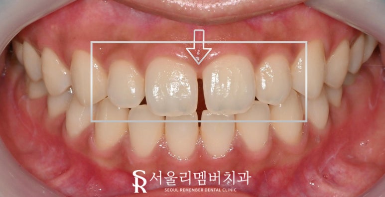 앞니 벌어짐, 레진 말고 라미네이트로 사이 틈새 자연스럽게 채우자 서울대입구 치과 상악 전치부 리얼네이트 케이스 관련 이미지 3