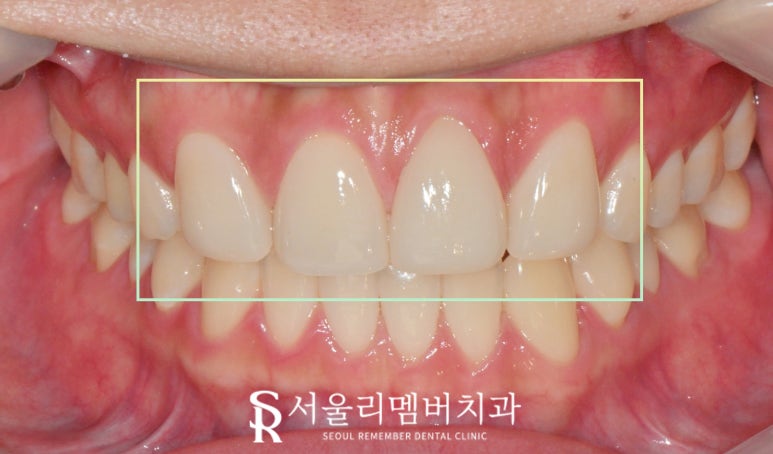 서울대입구 치과 결손된 앞니 자연스러운 라미 리얼네이트로 변색 레진과 사이 공간 막을 수 있다면 관련 이미지 4