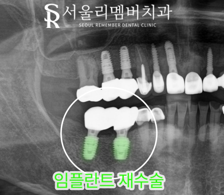 사당역 치과 임플란트 주위 염증으로 픽스처 제거 후 다시 식립 재수술 필요하다면? 관련 이미지 4