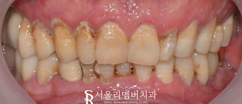 상도동 치과 다수의 충치, 임플란트와 신경치료 한 사례 (치경부 치석 관리의 중요성) 관련 이미지 1