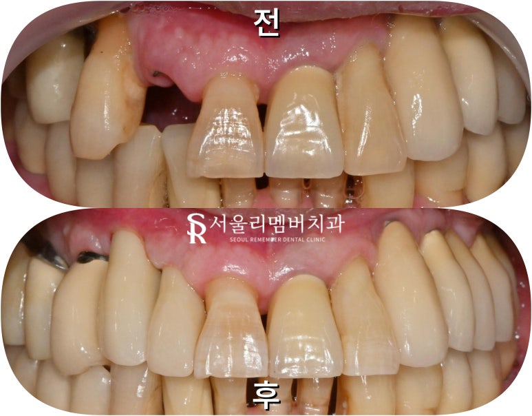 앞니 깨짐 및 충치, 임플란트 크라운 탈락 시 빠른 치료가 중요한 이유 서울대입구역 치과 관련 이미지 5