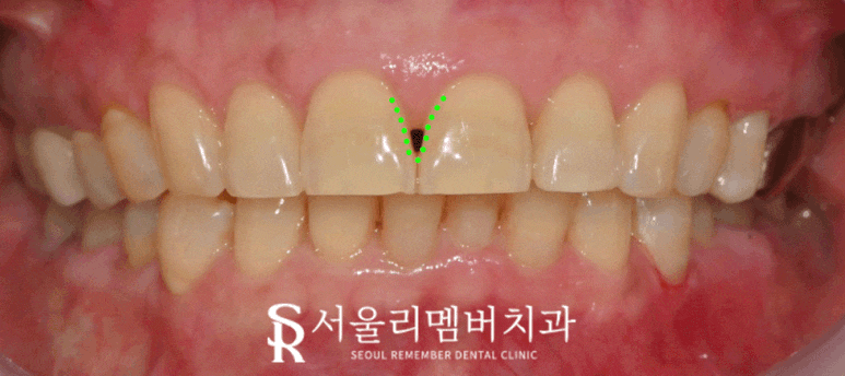 상도동 치과 심미 치료 잘하는 곳 찾는다면 관련 이미지 2