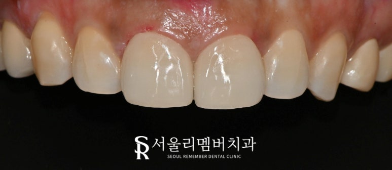 벌어진 앞니 사이 간격 고민이라면 교정? no 라미네이트? yes 서울대입구역치과 관련 이미지 2