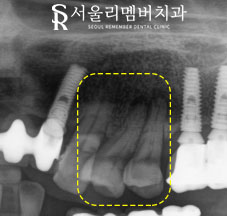 서울대입구역 치과 에서 작은 어금니 깊은 파임, 신경치료 후 통증 없는 크라운 진행 과정 알려드립니다. 관련 이미지 2