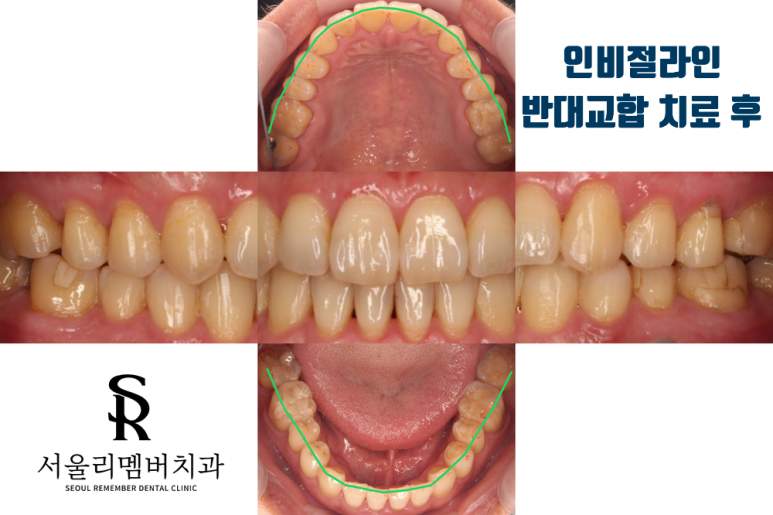 인비절라인 반대교합 치료 후 관련 이미지 1