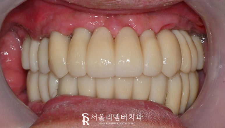 상도동 치과 위아래 다수의 치아 상실, 원가이드를 이용한 디지털 임플란트 로 상하악 전체 재건 가능 관련 이미지 7