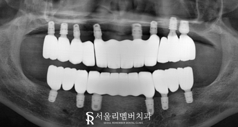 오랜 틀니 착용으로 잇몸이 다 망가졌던 분.. 임플란트 식립으로 밝은 미소 되찾아드렸습니다! 서울대입구역 서울 리멤버 치과 관련 이미지 7