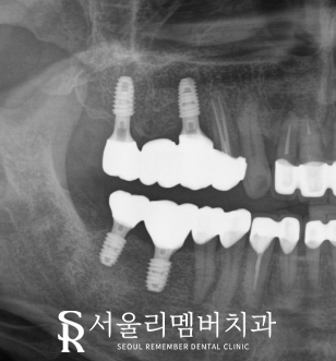 야간 진료 가능한 서울대입구역 치과 에서 퇴근 후에도 임플란트 하실 수 있습니다. 관련 이미지 4