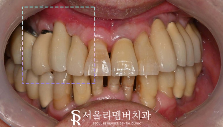 앞니 깨짐 및 충치, 임플란트 크라운 탈락 시 빠른 치료가 중요한 이유 서울대입구역 치과 관련 이미지 3