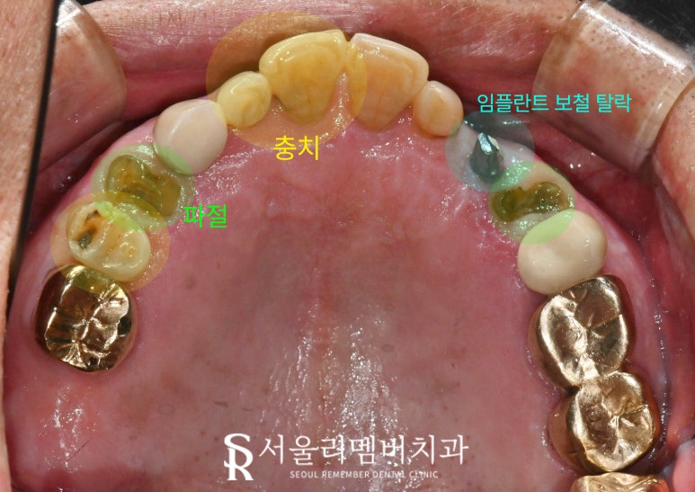 사당역 치과 충치, 치아 흔들림, 파절, 결손, 염증.. 다수의 복합 문제 생겼다면 임플란트 신경치료 크라운 과정 관련 이미지 2