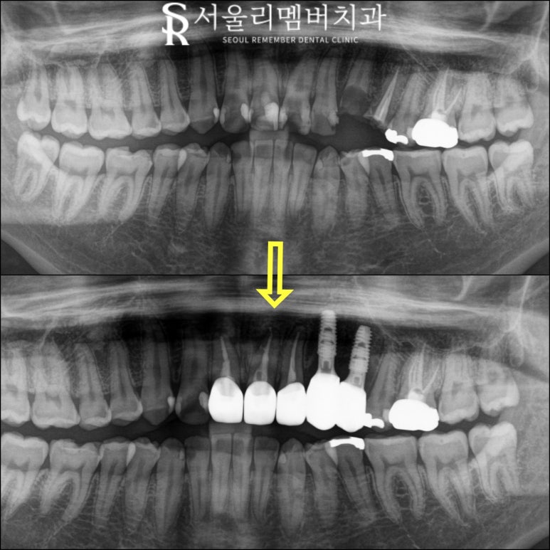 신대방 치과 "처음에는 작은 충치, 나중에는 치아 발치?" 앞니 임플란트 및 신경치료 후기 관련 이미지 4