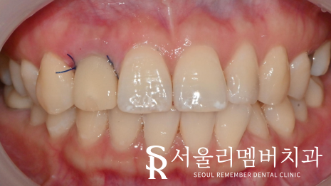 어? 전에 올려놨던 앞니 크라운이 갑자기 떨어졌어요 ! 신길동 치과 관련 이미지 3