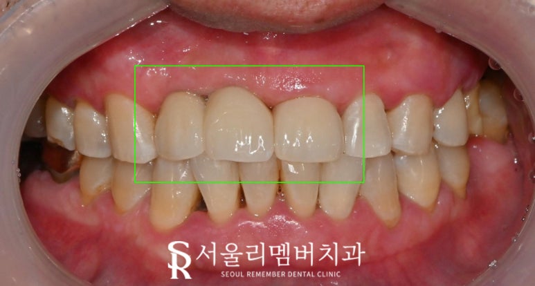 서울대입구 치과 환한 웃음을 되찾는 여정: 앞니 브릿지 탈락부터 임플란트를 통한 새로운 미소까지 관련 이미지 4