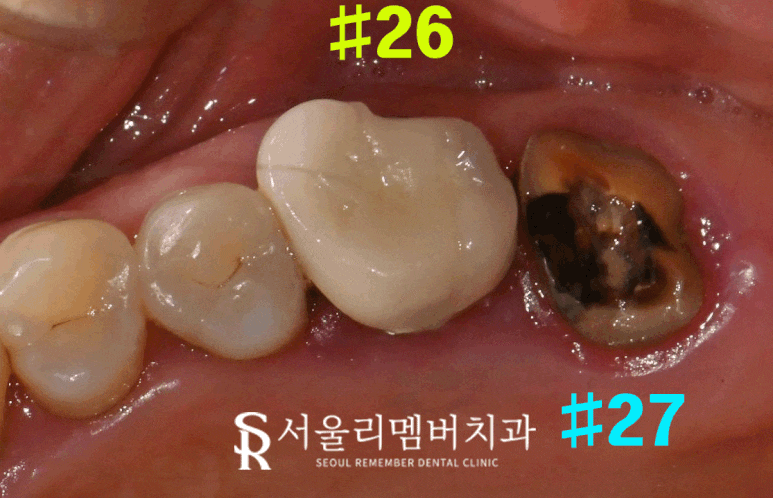 살리려던 어금니, 신경치료 시도 후 결국 임플란트로 복구한 보라매 치과 치료 사례 관련 이미지 3