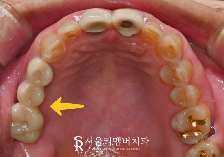"잇몸에 고름이 차고 흔들려요!" 서울대입구 임플란트 디지털 진료로 치료한 사례 관련 이미지 6