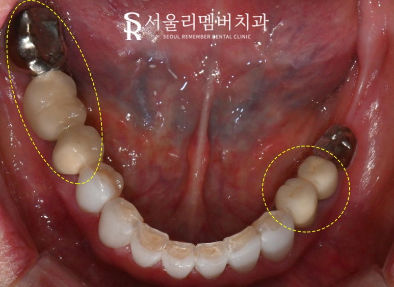 서울대입구역 치과 에서 오래된 어금니 브릿지 지르코니아 크라운 으로 교체해서 심미성 되찾아드렸습니다. 관련 이미지 1