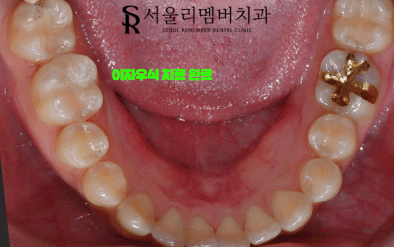 이차우식(secondary caries)이 생겼다면 어떻게 치료를 해야 될까? 서울대입구역 치과 관련 이미지 3