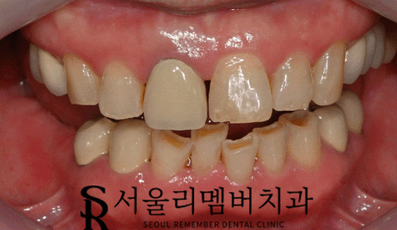 사당동 서울 리멤버 치과 "앞니가 깨졌는데 바로 진료 받을 수 있을까요..?" 관련 이미지 3