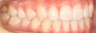 조기접촉 교정 후 관련 이미지 2