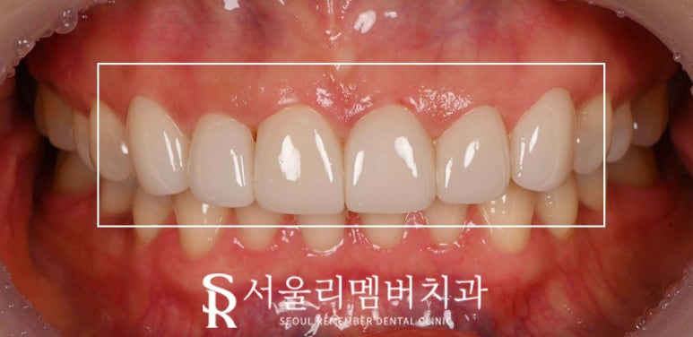 사당 치과 틀어지고 뻐드러진 앞니, 송곳니까지 리얼네이트 치료로 자연스러운 전치부 균형 찾기 관련 이미지 3