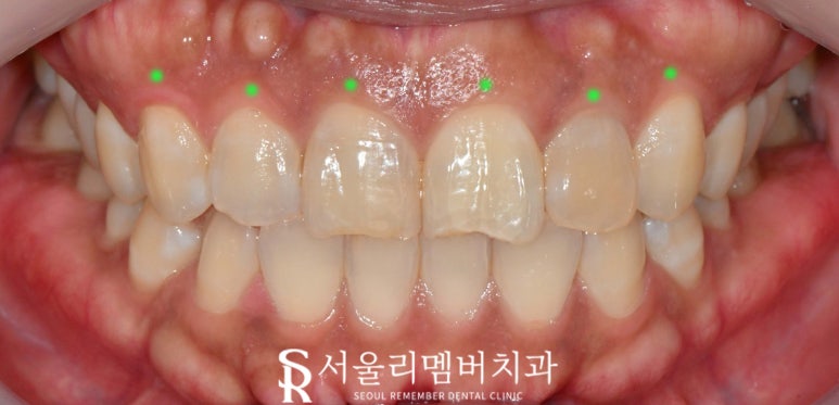 Maxillary Six-Anterior Veneers with RealNate for a Chipped Front Tooth with a Sharp, Rough Edge image 2