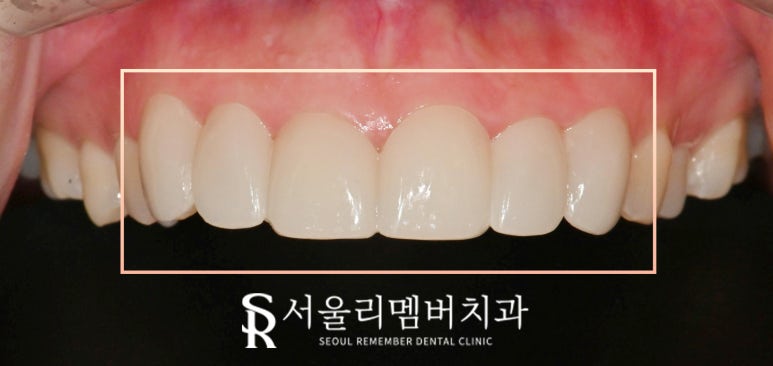 봉천동 치과 작은 앞니 왜소치 최소 삭제 및 통증 손상 없는 리얼 라미네이트 (Laminate)로 6전치 보철 수복 치료 관련 이미지 5