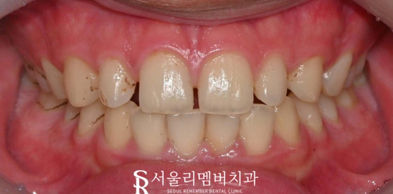 낙성대역 치과 에서 알려주는 스케일링 중요성 관련 이미지 2