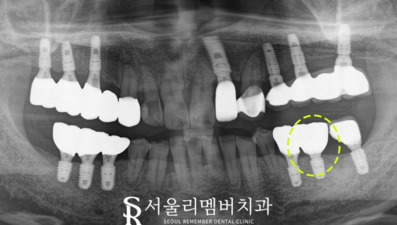 임플란트 잘하는 서울대입구역 치과 , 수면치료로 편안한 진료과정 관련 이미지 4