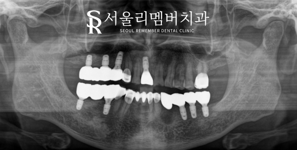 저작 기능을 살려주는 어금니 임플란트 식립 과정 서울대입구치과 관련 이미지 2