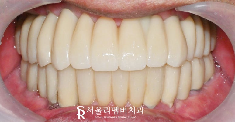 임플란트로 구강환경개선 신림역 치과 에서 깔끔하게 치료한 케이스 관련 이미지 7