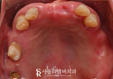 사당 치과 하악 전치 신경치료 브릿지로 살리고 나머지 임플란트로 재건한 전악 증례 관련 이미지 3