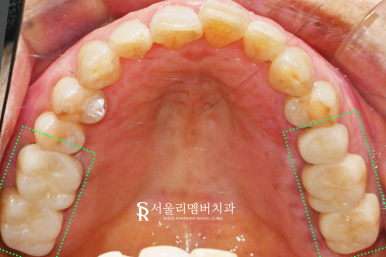 봉천동 치과 상실된 치아 방치하면 안 되는 이유 (feat.임플란트 브릿지 보철치료) 관련 이미지 8