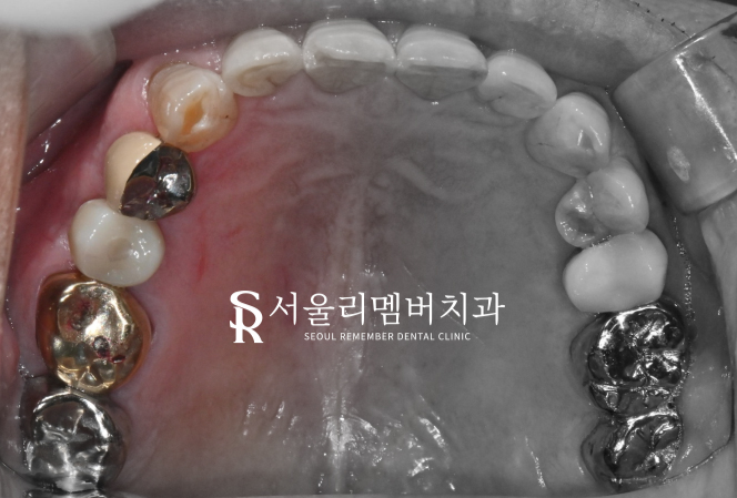 신길동 치과 임플란트에 대한 여러 소문들, 과연 사실일까? 관련 이미지 4