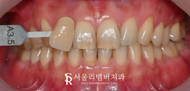 "변색 원인, 미백 방법, 주의사항까지" 서울대입구역 치과 에서 알려주는 하얀 치아를 위한 모든 것 관련 이미지 1