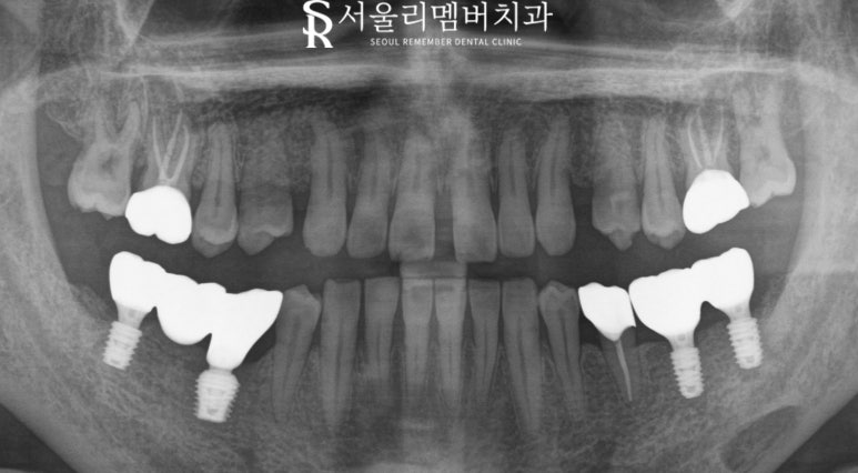 "오래된 크라운 있는 쪽으로 아파서 밥을 못 먹어요." 보라매 치과 임플란트 및 신경치료 후기 관련 이미지 4