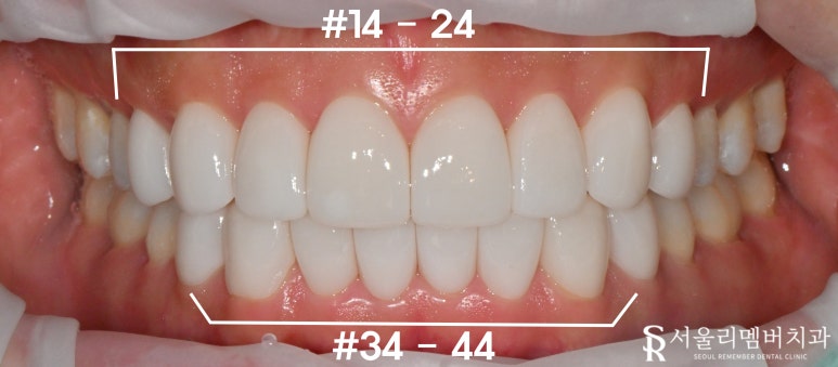 A Surge in Instagram DM Reservation Inquiries at Seoul National Univ. Entrance Station Dental Clinic: A Complete Rundown of Questions About Real Laminate image 6