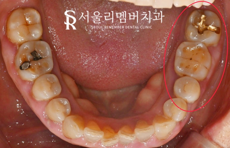 신림 치과 만 65세 이상 보험 임플란트 가격, 비용, 기간, 뼈이식, 크라운 종류 관련 이미지 1