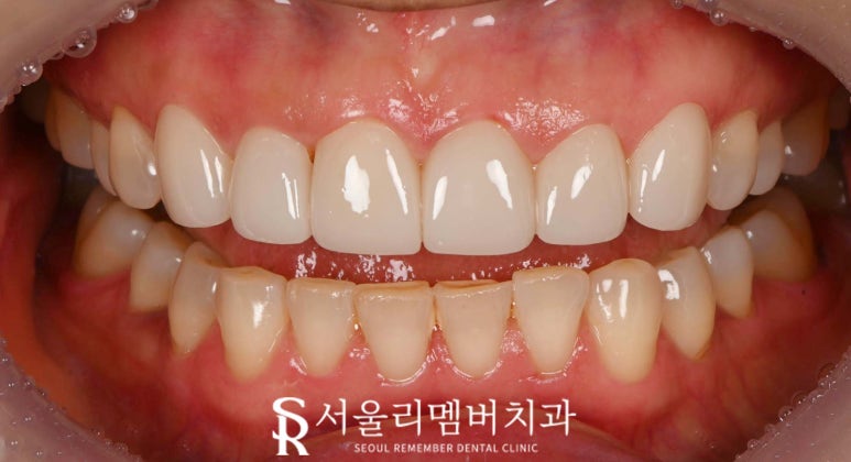 사당 치과 틀어지고 뻐드러진 앞니, 송곳니까지 리얼네이트 치료로 자연스러운 전치부 균형 찾기 관련 이미지 4