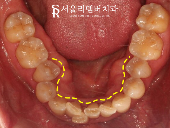 40대 교정 지금 시작해도 늦지 않을까요? 서울대입구역 치과 관련 이미지 4