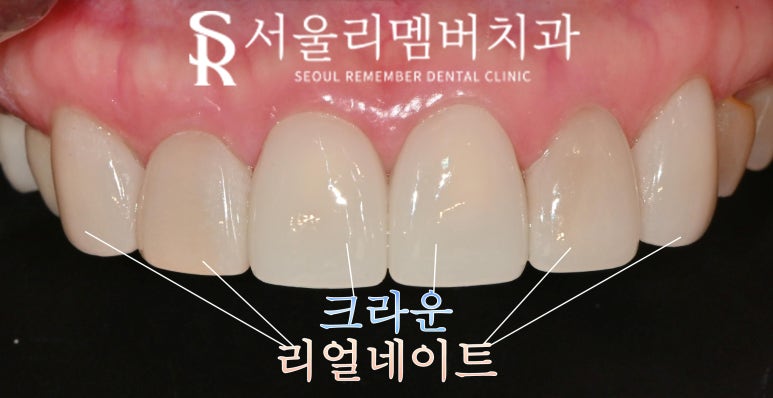 오래된 크라운 경계 불량, 이차 충치, 치경부 마모증은 앞니 라미네이트 적응증 봉천동 치과 의사 작성 관련 이미지 4