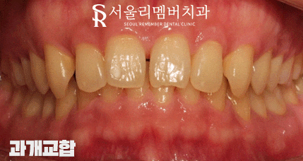 상도동치과 에서 발치 없이 깊게 물리는 과개교합 및 2급 부정교합 개선! 관련 이미지 1