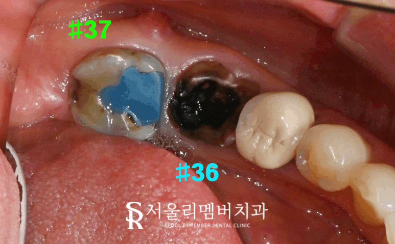 살리려던 어금니, 신경치료 시도 후 결국 임플란트로 복구한 보라매 치과 치료 사례 관련 이미지 4