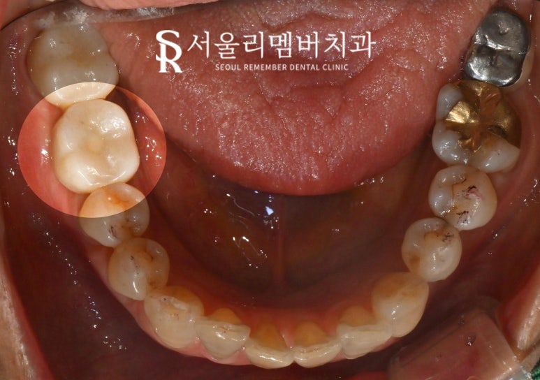 Root Fracture Caused by Secondary Decay Under a Gold Crown, Immediate Implant After Extraction at Sadang Station Dental Clinic image 5