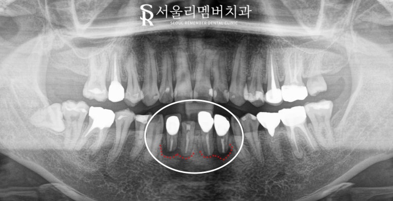 아래 앞니 부러짐 뿌리 끝 염증 봉천동 치과 하악 4전치 발치 후 오스템 임플란트 관련 이미지 4