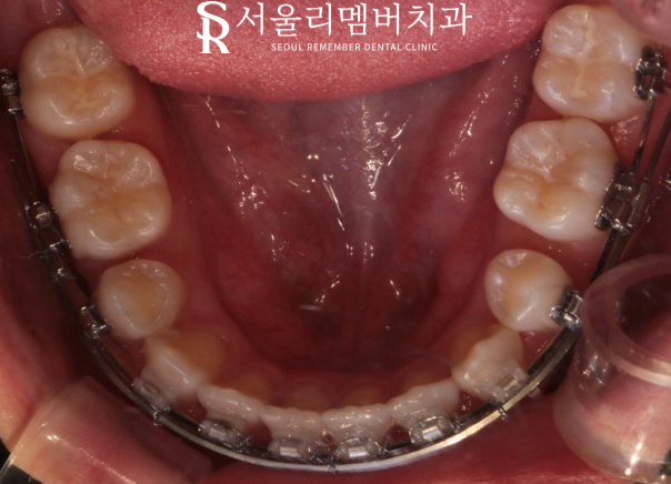 서울대입구역 치과 툭 튀어나온 돌출 때문에 발치교정 진행 관련 이미지 7
