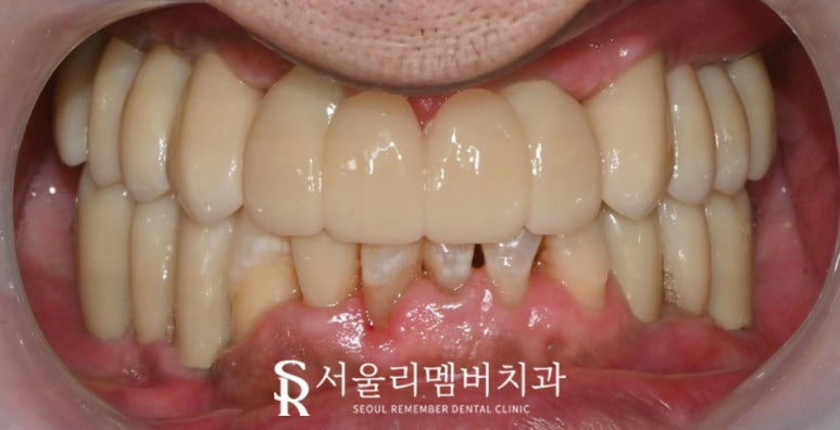 사당 치과, 틀니 대신 전체 임플란트로 새로운 구강 환경 되찾아 드린 사례 관련 이미지 4