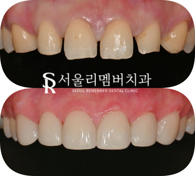 앞니 치료, 이제는 자연스러움이 답이다! 봉천동 치과 진짜 같은 라미네이트 "리얼네이트" 관련 이미지 7