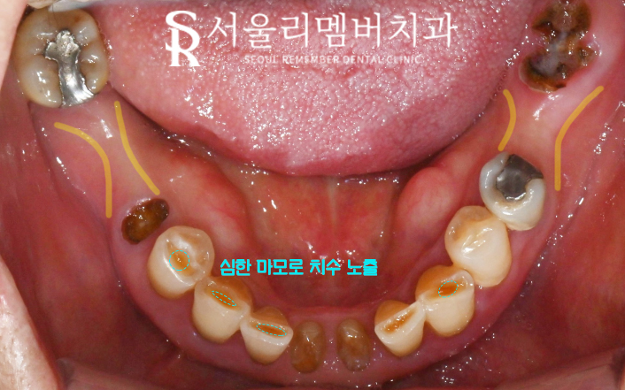 서울대입구역 치과 에서 수면(의식하진정)요법 동반한 전체 임플란트 식립 관련 이미지 3