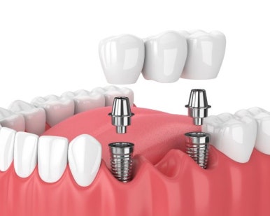 봉천동 치과 에서 신경치료 및 브릿지로 깨진 치아 회복하기 관련 이미지 2